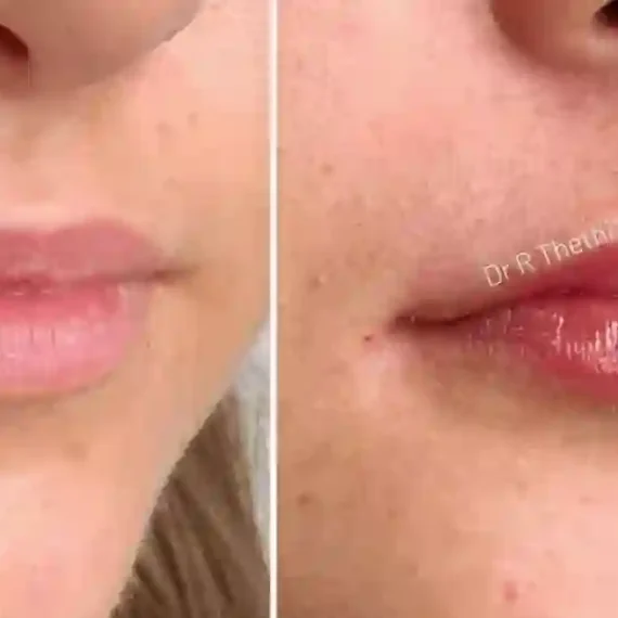 Fillers Before And After